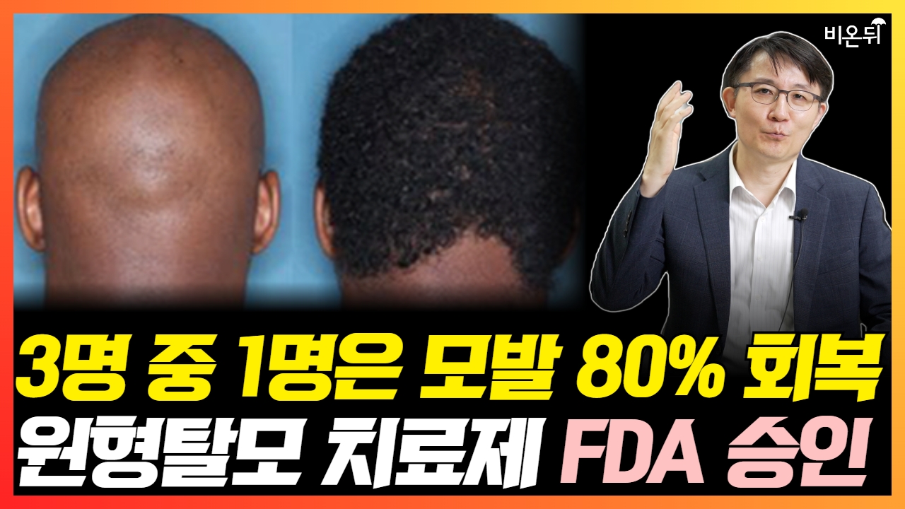 원형탈모 치료의 새 길이 열리다! 3명 중 1명은 모발 80% 회복, 원형탈모 치료제 FDA 승인 (서울대학교병원 피부과 권오상)